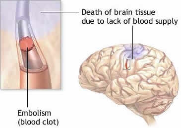 Modificarile hemodinamice si metabolice in accidentul vascular cerebral